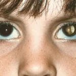 Brasil registra 24 casos confirmados de intoxicação por metanol e investiga outros 235