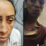 Garota de 14 anos passa por cirurgia de 17h para remover a perna de 79kg